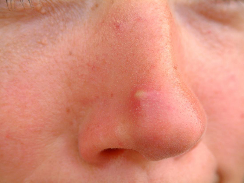 Mũi là vị trí dễ mọc mụn nhất do tính chất vùng da này tích tụ khá nhiều chất nhờn, bụi bẩn