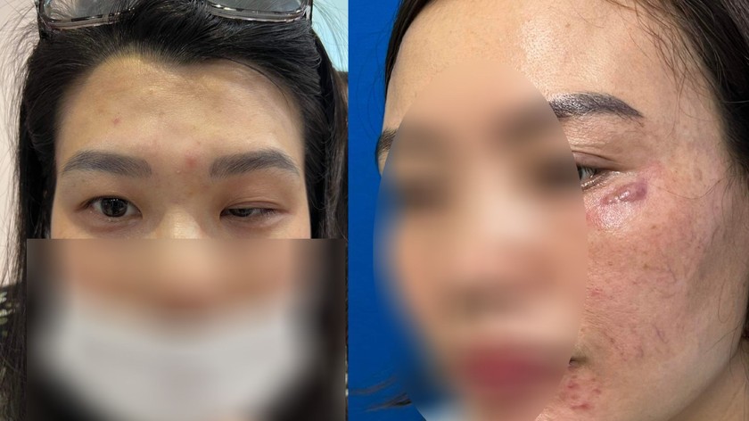Phồng hàm, xệ mắt, nguy cơ biến chứng kéo dài vì tiêm Botox 'chỗ người quen' | Báo Pháp luật Việt Nam điện tử